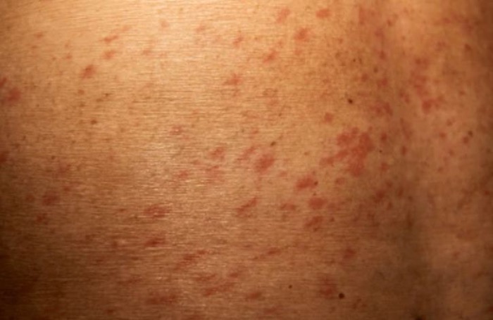 Токсикодермія лікування в Києві на Печерську - Derm.Com