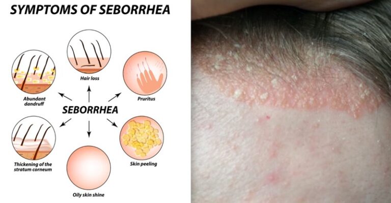 Себорейний дерматит лікування - Derm.Com