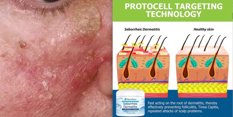 Себорейний дерматит лікування - Derm.Com